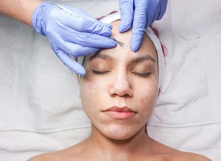 Acne Scar Reduction