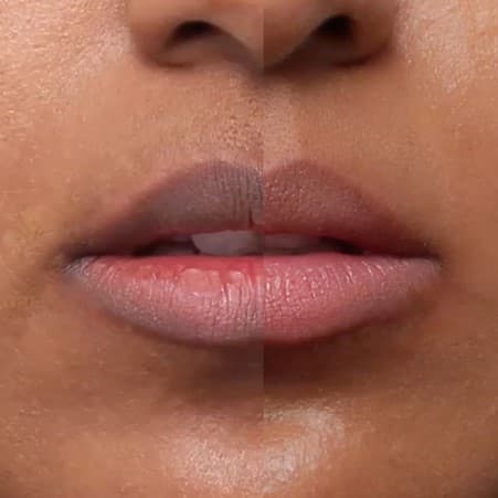 Lip Lightening Treatment