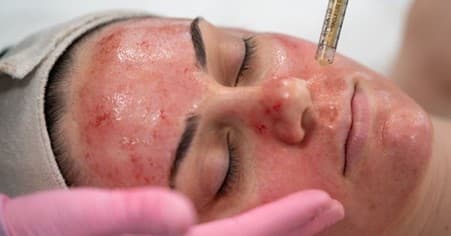 Vampire Facial (PRP)