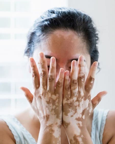 Vitiligo